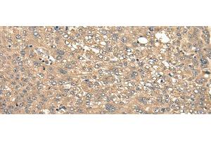 Immunohistochemistry of paraffin-embedded Human liver cancer tissue using CIR1 Polyclonal Antibody at dilution of 1:40(x200) (CIR1 抗体)