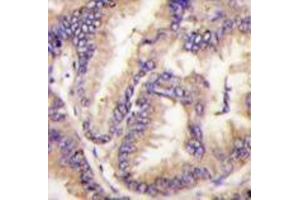 Formalin-fixed and paraffin-embedded human lung carcinoma tissue reacted with STK9 Antibody (C-term) , which was peroxidase-conjugated to the secondary antibody, followed by DAB staining. (CDKL5 抗体  (C-Term))