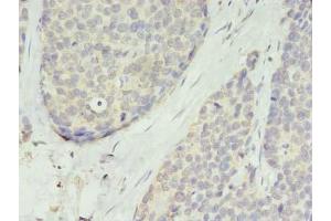 Immunohistochemistry of paraffin-embedded human gastric cancer using ABIN7173225 at dilution of 1:100 (TMEM45A 抗体  (AA 171-217))