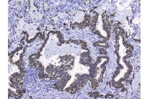 IHC analysis of Cytokeratin 19 using anti-Cytokeratin 19 antibody (ABIN3043288). (Cytokeratin 19 抗体  (C-Term))
