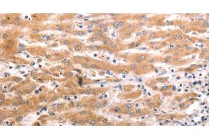Immunohistochemistry of paraffin-embedded Human liver cancer tissue using HCRTR1 Polyclonal Antibody at dilution 1:70