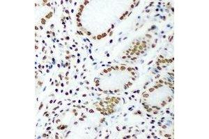 Immunohistochemical analysis of DR1 staining in human gastric cancer formalin fixed paraffin embedded tissue section. (DR1 抗体)