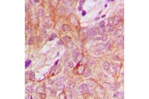 Immunohistochemical analysis of PPM1K staining in human breast cancer formalin fixed paraffin embedded tissue section. (PPM1K 抗体)