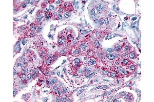 Anti-GRM8 / MGLUR8 antibody IHC of human Pancreas, Carcinoma. (GRM8 抗体  (N-Term))