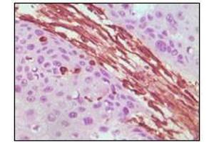 Immunohistochemical analysis of paraffin-embedded human lung carcinoma tissue, showing cytoplasmic localization using Vimentin antibody with DAB staining. (Vimentin 抗体)