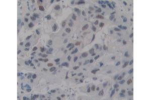 IHC-P analysis of breast tissue, with DAB staining. (TDP1 抗体  (AA 4-215))