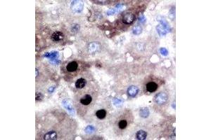 Immunohistochemical analysis of BCL11A staining in human liver cancer formalin fixed paraffin embedded tissue section. (BCL11A 抗体)