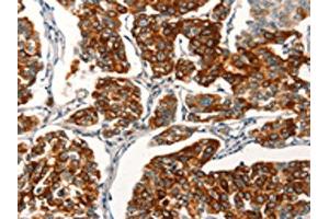 The image on the left is immunohistochemistry of paraffin-embedded Human breast cancer tissue using ABIN7189718(AGO4 Antibody) at dilution 1/25, on the right is treated with synthetic peptide. (AGO4 抗体)