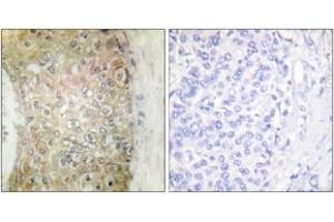 Immunohistochemistry analysis of paraffin-embedded human breast carcinoma tissue, using HSP20 (Ab-16) Antibody. (HSPB6 抗体  (AA 5-54))