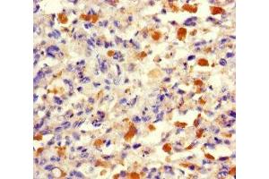 Immunohistochemistry of paraffin-embedded human melanoma using ABIN7173512 at dilution of 1:100 (TRMT112 抗体  (AA 1-125))