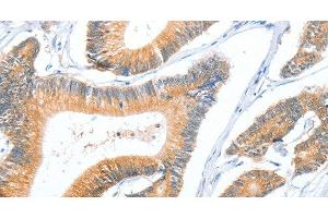 Immunohistochemistry of paraffin-embedded Human colon cancer using ACY3 Polyclonal Antibody at dilution of 1:35 (Aminoacylase 3 抗体)