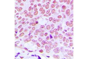 Immunohistochemical analysis of c-Jun staining in human breast cancer formalin fixed paraffin embedded tissue section. (C-JUN 抗体  (Center))