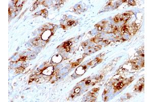 Formalin-fixed, paraffin-embedded human Colon Carcinoma stained with CEA Mouse Monoclonal Antibody (CEA31). (CEACAM5 抗体)