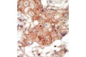 Formalin-fixed and paraffin-embedded human cancer tissue reacted with the primary antibody, which was peroxidase-conjugated to the secondary antibody, followed by DAB staining. (EPH Receptor A4 抗体  (C-Term))