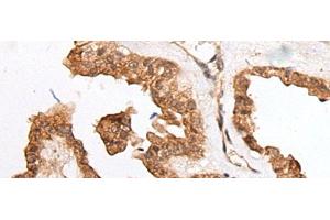 Immunohistochemistry of paraffin-embedded Human thyroid cancer tissue using HOXB9 Polyclonal Antibody at dilution of 1:45(x200) (HOXB9 抗体)