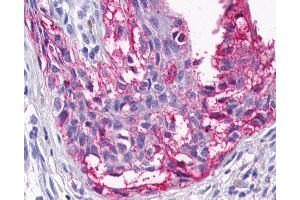 Anti-HTR4 / 5-HT4 Receptor antibody IHC of human Skin, Melanoma. (Serotonin Receptor 4 抗体  (Cytoplasmic Domain))