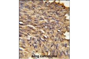 Formalin-fixed and paraffin-embedded human lung carcinoma reacted with HDLBP Antibody (Center), which was peroxidase-conjugated to the secondary antibody, followed by DAB staining. (HDLBP 抗体  (AA 764-791))