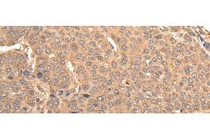 Immunohistochemistry of paraffin-embedded Human liver cancer tissue using BUD31 Polyclonal Antibody at dilution of 1:75(x200) (BUD31 抗体)