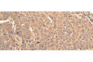 Immunohistochemistry of paraffin-embedded Human liver cancer tissue using BUD31 Polyclonal Antibody at dilution of 1:75(x200)