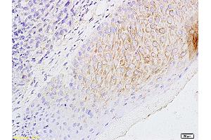 Formalin-fixed and paraffin embedded mouse foot tumor labeled with Anti-CCL21/6CKINE Polyclonal Antibody, Unconjugated (ABIN732698) followed by conjugation to the secondary antibody and DAB staining (CCL21 抗体  (AA 24-134))