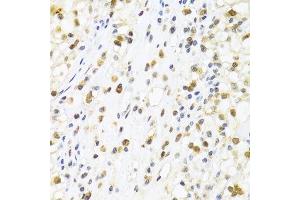 Immunohistochemistry of paraffin-embedded human kidney cancer using SUMO4 Antibody. (SUMO4 抗体)
