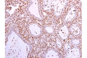CDK6 antibody [N1C3] detects CDK6 protein at cytoplasm and nucleus in human lung adenocarcinoma by immunohistochemical analysis. (CDK6 抗体)
