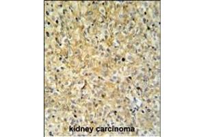 PK1IP1L Antibody (Center) (ABIN653686 and ABIN2843011) IHC analysis in forlin fixed and paraffin embedded kidney carcino followed by peroxidase conjugation of the secondary antibody and DAB staining. (MAPK1IP1L 抗体  (AA 108-137))