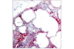 Immunohistochemical analysis of paraffin-embedded human breast carcinoma tissue using ATF2(Phospho-Ser62 or 44) Antibody.