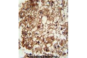 CD11b antibody (N-term) immunohistochemistry analysis in formalin fixed and paraffin embedded human hepatocarcinoma followed by peroxidase conjugation of the secondary antibody and DAB staining. (CD11b 抗体  (N-Term))