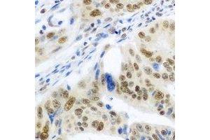 Immunohistochemical analysis of IRF-6 staining in human colon cancer formalin fixed paraffin embedded tissue section. (IRF6 抗体)