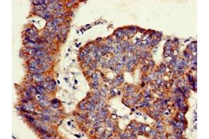 Immunohistochemistry of paraffin-embedded human colon cancer using ABIN7145493 at dilution of 1:100 (GLB1 抗体  (AA 317-455))