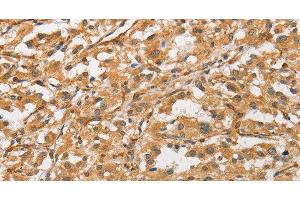 Immunohistochemistry of paraffin-embedded Human thyroid cancer tissue using ARMCX1 Polyclonal Antibody at dilution 1:40 (ARMCX1 抗体)