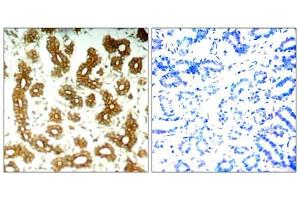 Immunohistochemical analysis of paraffin-embedded human breast carcinoma tissue using Keratin 8 (Ab-73) antibody (E021307). (Cytokeratin 18 抗体)