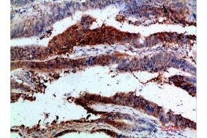 Immunohistochemical analysis of paraffin-embedded human-colon-cancer, antibody was diluted at 1:200