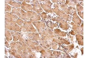 IHC-P Image GSTT1 antibody detects GSTT1 protein at cytosol on human gastric cancer by immunohistochemical analysis. (GSTT1 抗体)