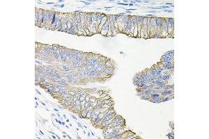 Immunohistochemistry of paraffin-embedded human colon carcinoma using ACVR2A antibody at dilution of 1:100 (x40 lens). (ACVR2A 抗体)