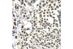 Immunohistochemistry of paraffin-embedded human breast cancer using IRF2 antibody.