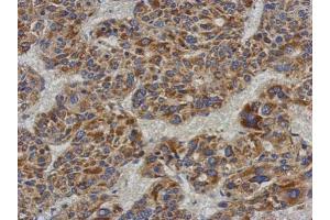 IHC-P Image Immunohistochemical analysis of paraffin-embedded human hepatoma, using ACADL, antibody at 1:500 dilution. (ACADL 抗体  (N-Term))