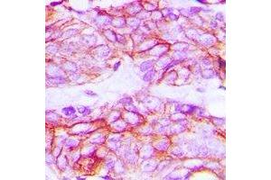 Immunohistochemical analysis of VEGFR2 (pY1214) staining in human breast cancer formalin fixed paraffin embedded tissue section. (VEGFR2/CD309 抗体  (C-Term, pTyr1214))