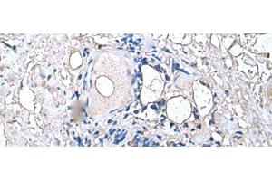 Immunohistochemistry of paraffin-embedded Human thyroid cancer tissue using PTP4A1 Polyclonal Antibody at dilution of 1:45(x200) (PTP4A1 抗体)