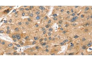 Immunohistochemistry of paraffin-embedded Human liver cancer using SORT1 Polyclonal Antibody at dilution of 1:35 (Sortilin 1 抗体)