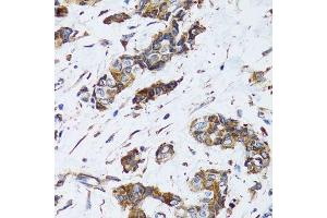 Immunohistochemistry of paraffin-embedded human breast cancer using PGRMC1 antibody. (PGRMC1 抗体  (AA 44-195))