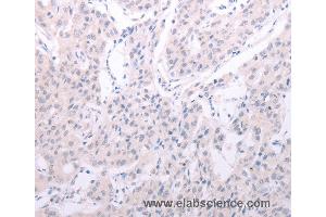 Immunohistochemistry of Human lung cancer using SPATA6 Polyclonal Antibody at dilution of 1:40 (SPATA6 抗体)