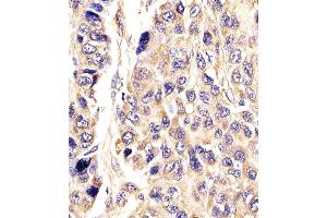 Antibody staining AGXT in Human hepatic carcinoma tissue sections by Immunohistochemistry (IHC-P - paraformaldehyde-fixed, paraffin-embedded sections). (AGXT 抗体  (AA 96-125))