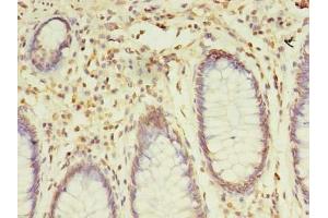 Immunohistochemistry of paraffin-embedded human colon cancer using ABIN7170377 at dilution of 1:100 (SNX24 抗体  (AA 1-169))