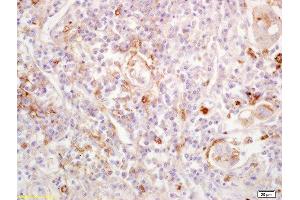Formalin-fixed and paraffin embedded human lung carcinoma labeled with Anti-EDG1/CD363/S1P1 Polyclonal Antibody, Unconjugated  at 1:200 followed by conjugation to the secondary antibody and DAB staining. (S1PR1 抗体  (AA 51-150))