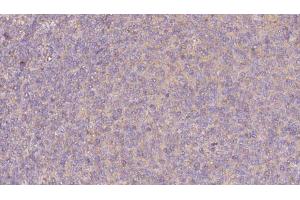 ABIN6273067 at 1/100 staining Human lymph cancer tissue by IHC-P. (PRPH2 抗体  (Internal Region))