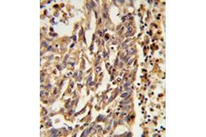Formalin-fixed and paraffin-embedded human lung carcinoma reacted with KIF11 Antibody (N-term) followed which was peroxidase-conjugated to the secondary antibody, followed by DAB staining. (KIF11 抗体  (N-Term))