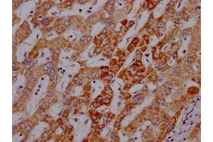 IHC image of ABIN7127339 diluted at 1:100 and staining in paraffin-embedded human liver cancer performed on a Leica BondTM system. (Recombinant Angiopoietin 2 抗体)