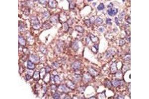 IHC analysis of FFPE human breast carcinoma tissue stained with the SYVN1 antibody (SYVN1 抗体  (AA 586-617))